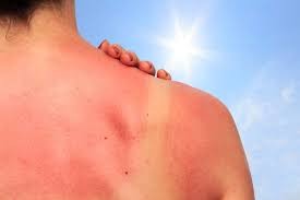 Как успокоить кожу после солнечного ожога: советы врача