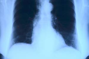 В прошлом году 144 астраханца умерли от туберкулёза