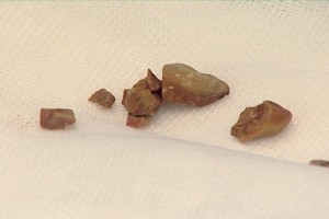 Астраханские хирурги-урологи освоили операции по удалению больших камней из почек малоинвазивными способами