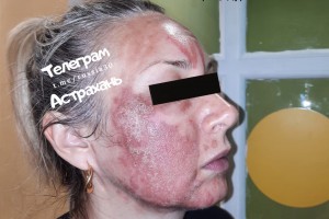 Астраханка получила многочисленные ожоги от косметологической процедуры