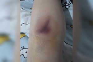 В Астраханской области собака напала на ребенка