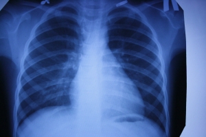 Чем опасен туберкулёз и как его лечат в местах лишения свободы?