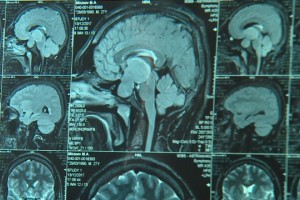 Астраханские врачи провели первую в этом году уникальную операцию по клипированию аневризмы головного мозга