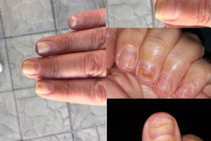 Мастер маникюра из Астраханской области превратила ногти клиентки в обрубки